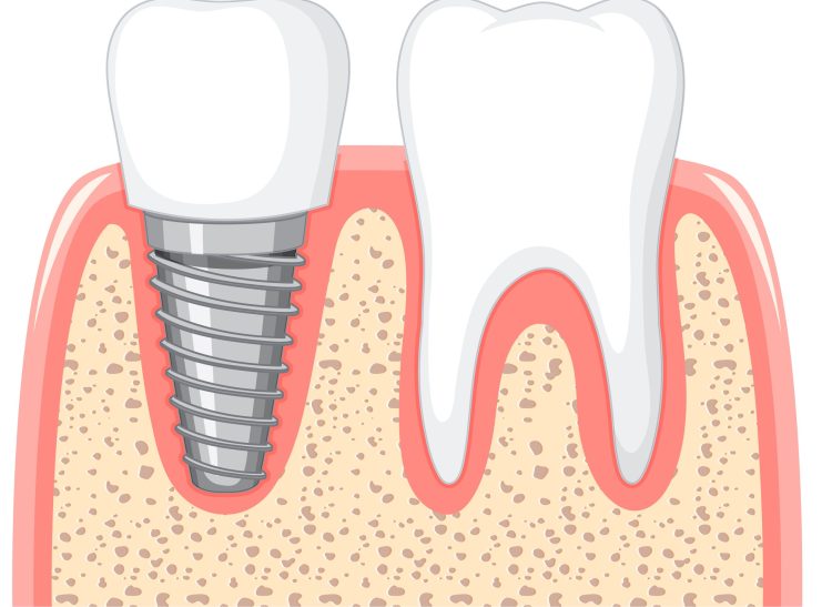 implantologia-dentale-viti-titanio